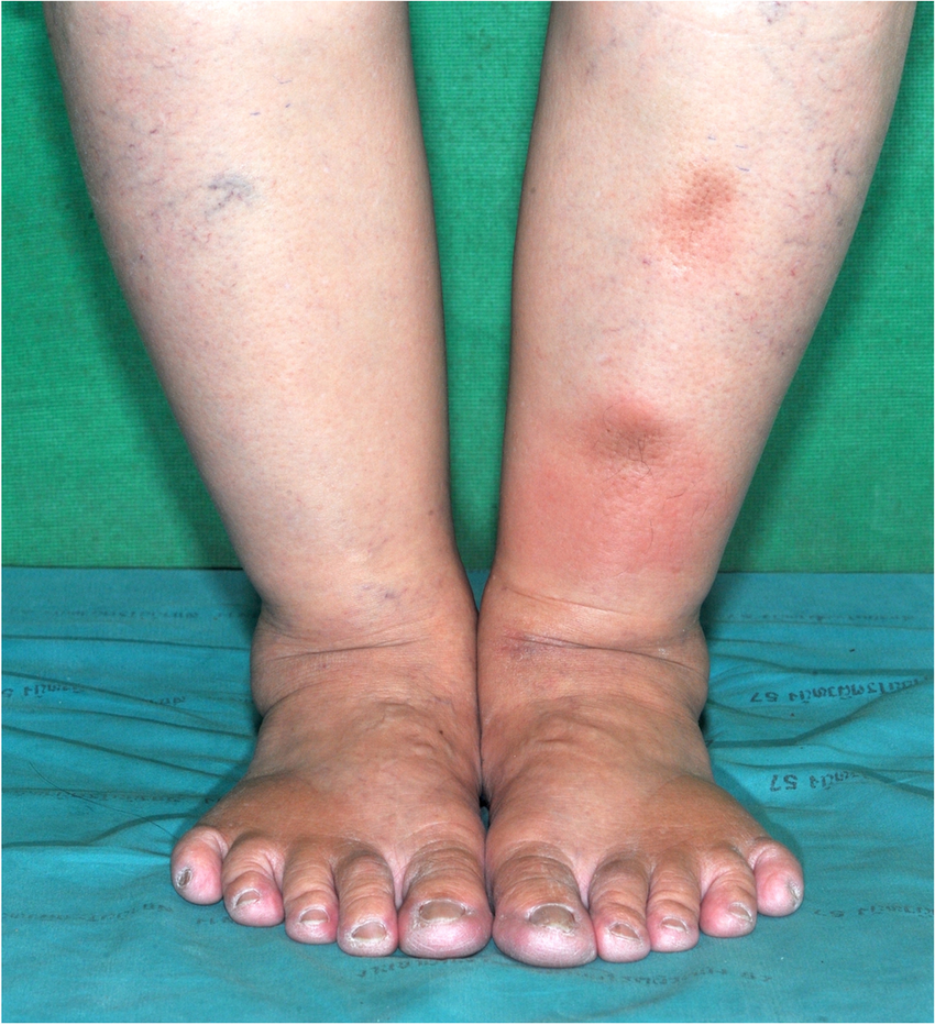 Lower leg with tender, firm, red area from acute lipodermatosclerosis