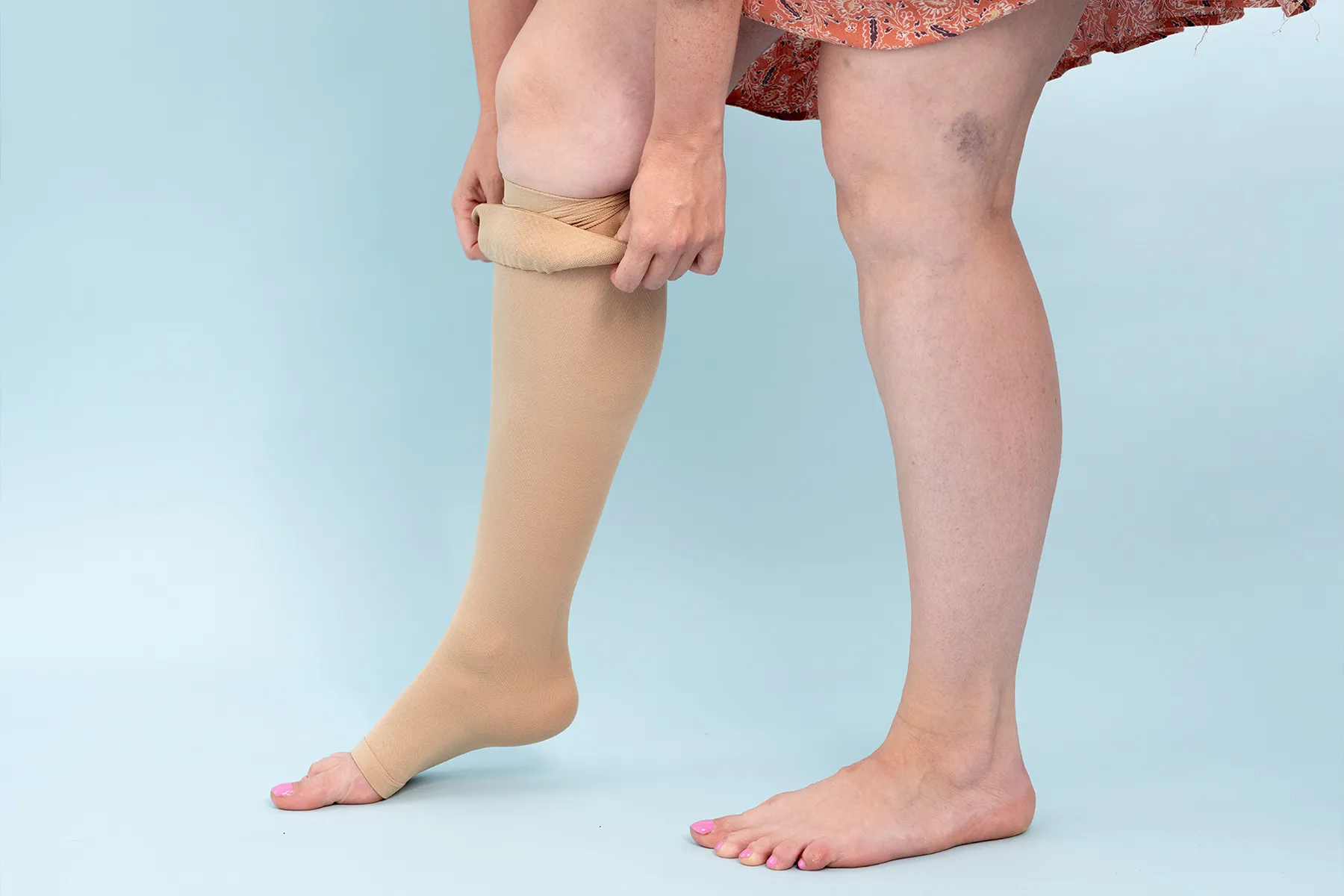 Person wearing a compression stocking for vein support.