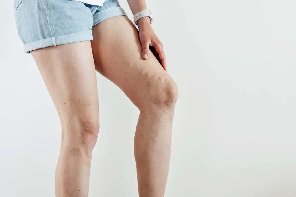 Visible varicose veins on upper leg indicating circulation issues.