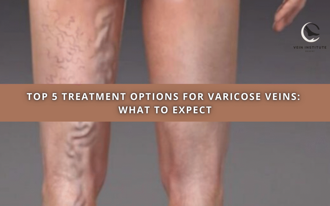 Top 5 Treatment Options for Varicose Veins: What to Expect