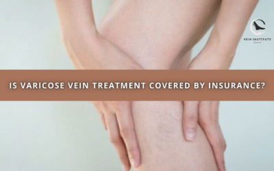 Is Varicose Vein Treatment Covered by Insurance?