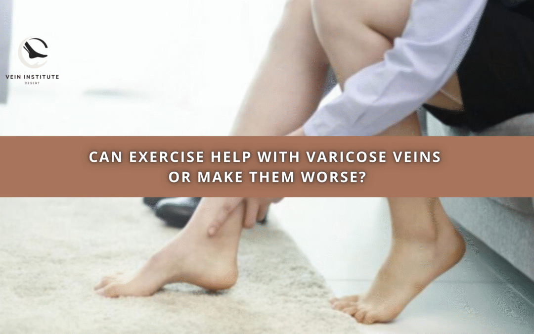 Can Exercise Help With Varicose Veins or Make Them Worse?
