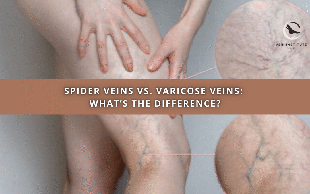 Spider Veins vs. Varicose Veins: What’s the Difference?