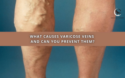 What Causes Varicose Veins and Can You Prevent Them?