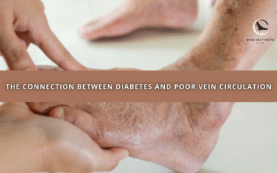 The Connection Between Diabetes and Poor Vein Circulation