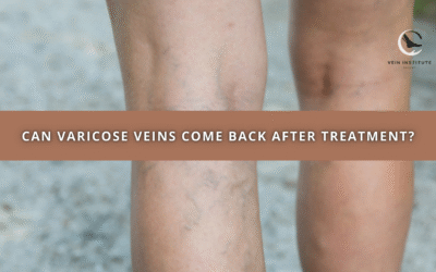 Can Varicose Veins Come Back After Treatment?
