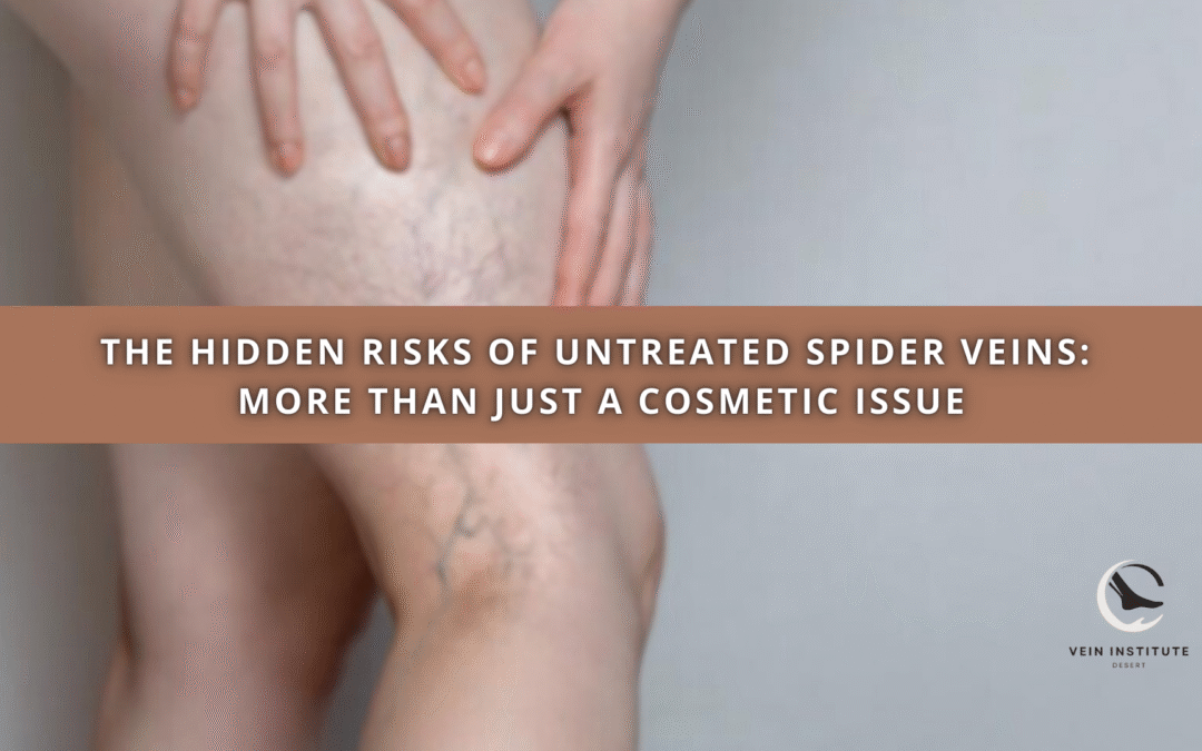 The Hidden Risks of Untreated Spider Veins: More Than Just a Cosmetic Issue