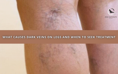 What Causes Dark Veins on Legs and When to Seek Treatment