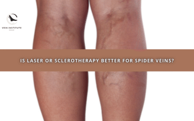 Is Laser or Sclerotherapy Better for Spider Veins?
