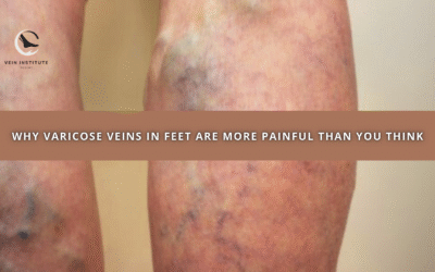 Why Varicose Veins in Feet Are More Painful Than You Think