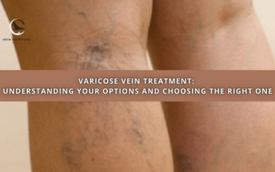 Varicose Vein Treatment: Understanding Your Options and Choosing the Right One