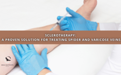 Sclerotherapy: A Proven Solution for Treating Spider and Varicose Veins