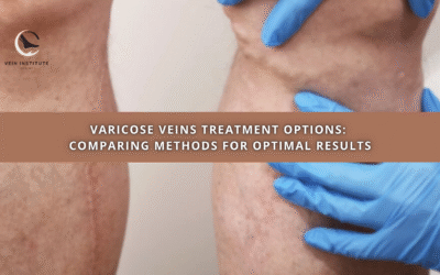 Varicose Veins Treatment Options: Comparing Methods for Optimal Results