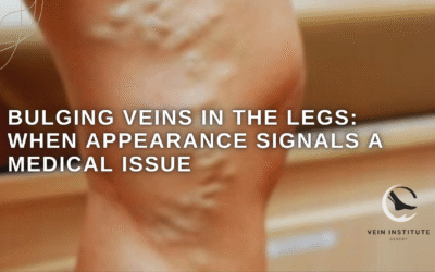 Bulging Veins in the Legs: When Appearance Signals a Medical Issue