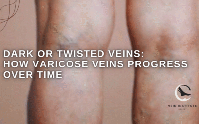 Dark or Twisted Veins: How Varicose Veins Progress Over Time