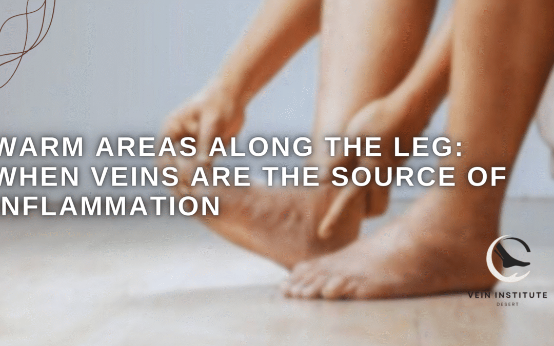 Warm Areas Along the Leg: When Veins Are the Source of Inflammation