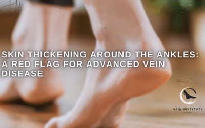 Skin Thickening Around the Ankles: A Red Flag for Advanced Vein Disease