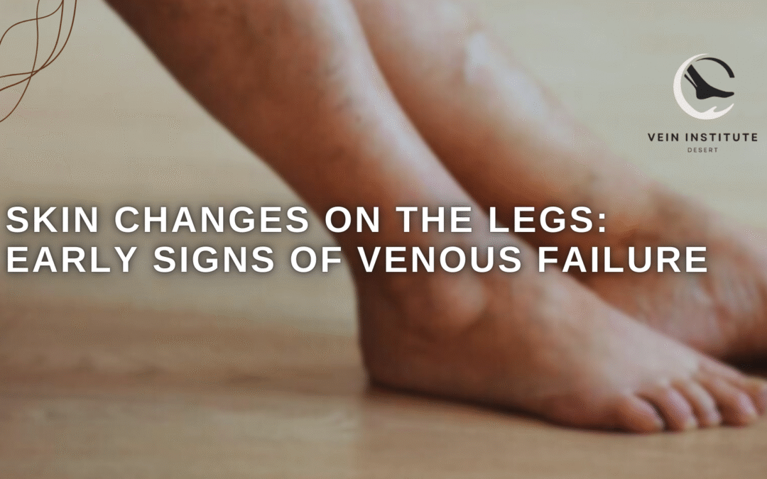 Skin Changes on the Legs: Early Signs of Venous Failure
