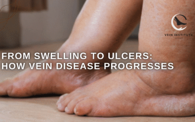 From Swelling to Ulcers: How Vein Disease Progresses