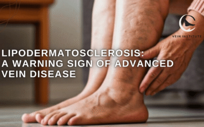 Lipodermatosclerosis: A Warning Sign of Advanced Vein Disease
